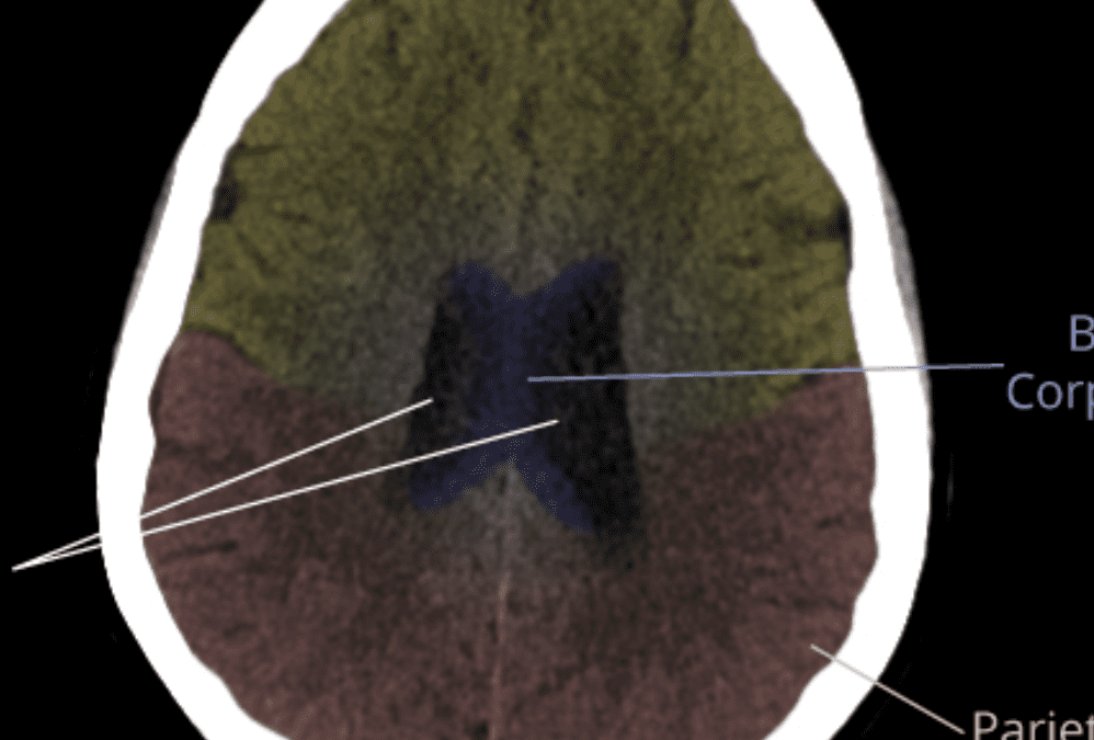 CT Brain Anatomy