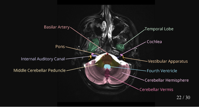 mri brain scan anatomy