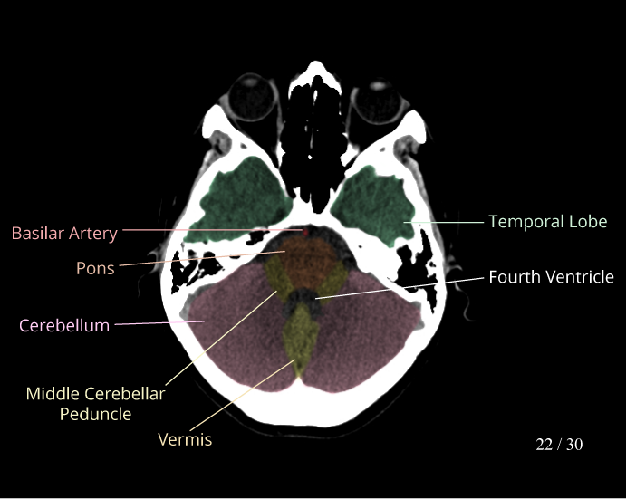normal brain ct anatomy