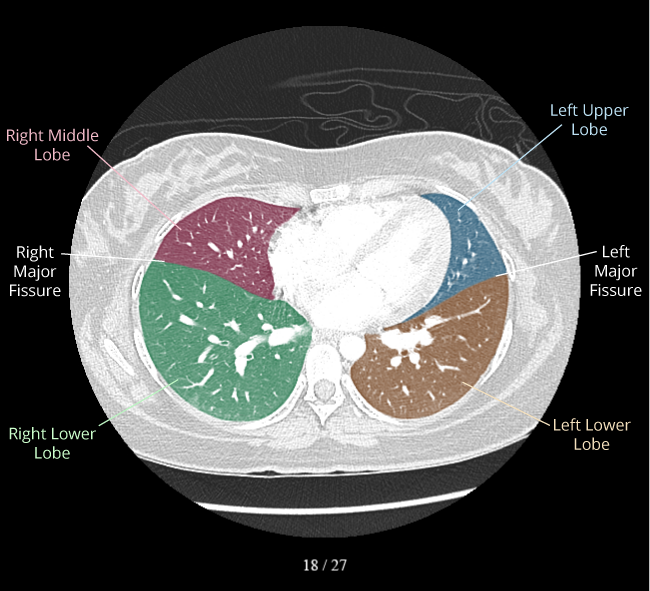 Sagittal Ct