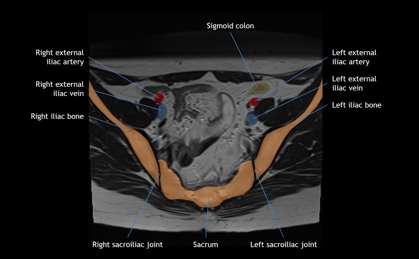 Bony pelvis, Radiology Reference Article