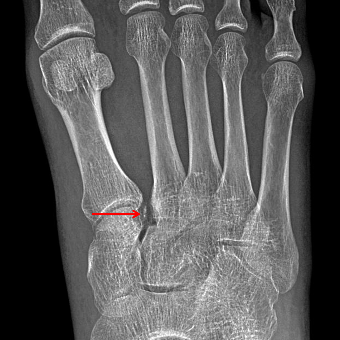 2nd metatarsal fracture