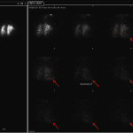 Concentration and retention of xenon in the liver in this patient with hepatic steatosis (red arrows).