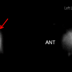 Attenuation artifact associated with the patient's pacemaker, which results in a round area of photopenia in the upper lung (red arrow).