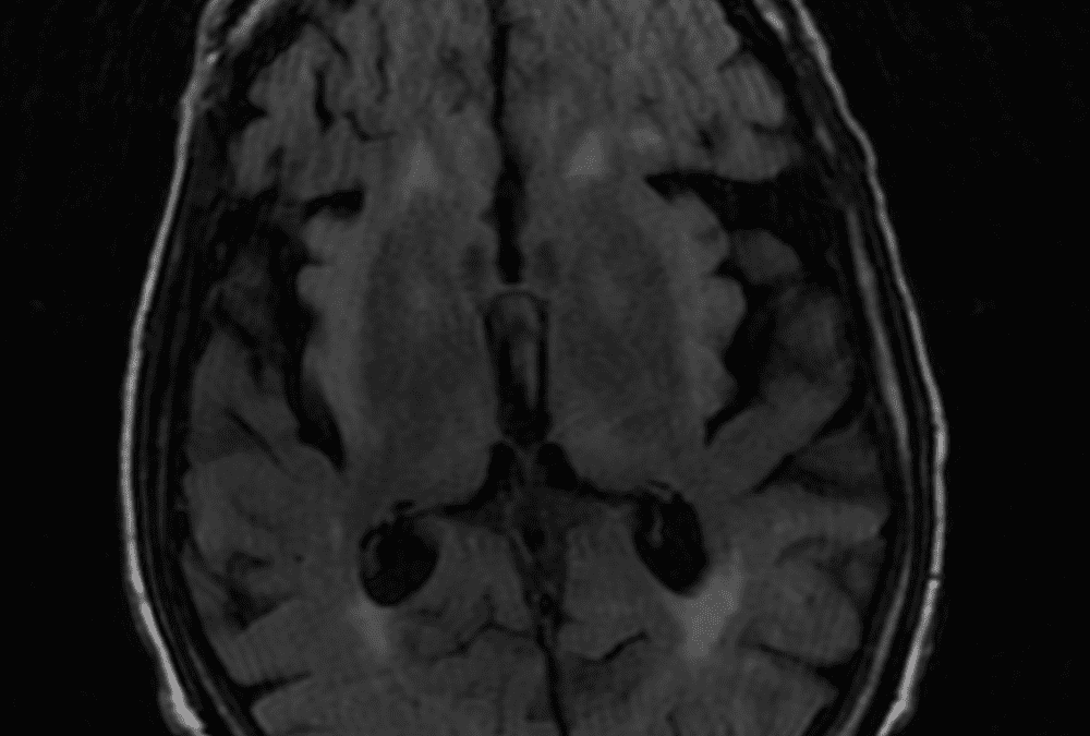 Hyperammonemic Encephalopathy