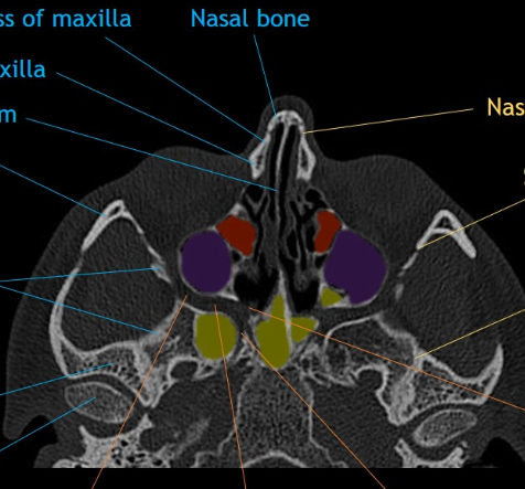 CT Axial Face Anatomy