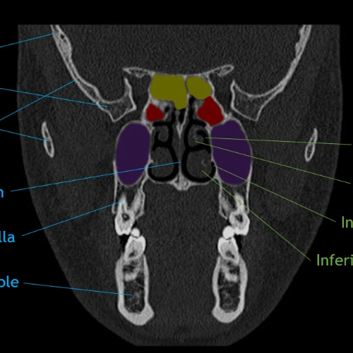 CaseStacks.com - MS1 Anatomy Coronal Face CT Anatomy