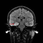 Expansile area of T2/FLAIR hyperintensity in the right parahippocampal gyrus and fusiform gyrus (red arrow), later proven to represent a low-grade glioma.