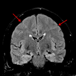 Areas of FLAIR signal hyperintensity within sulci (red arrows) in this patient with meningitis.