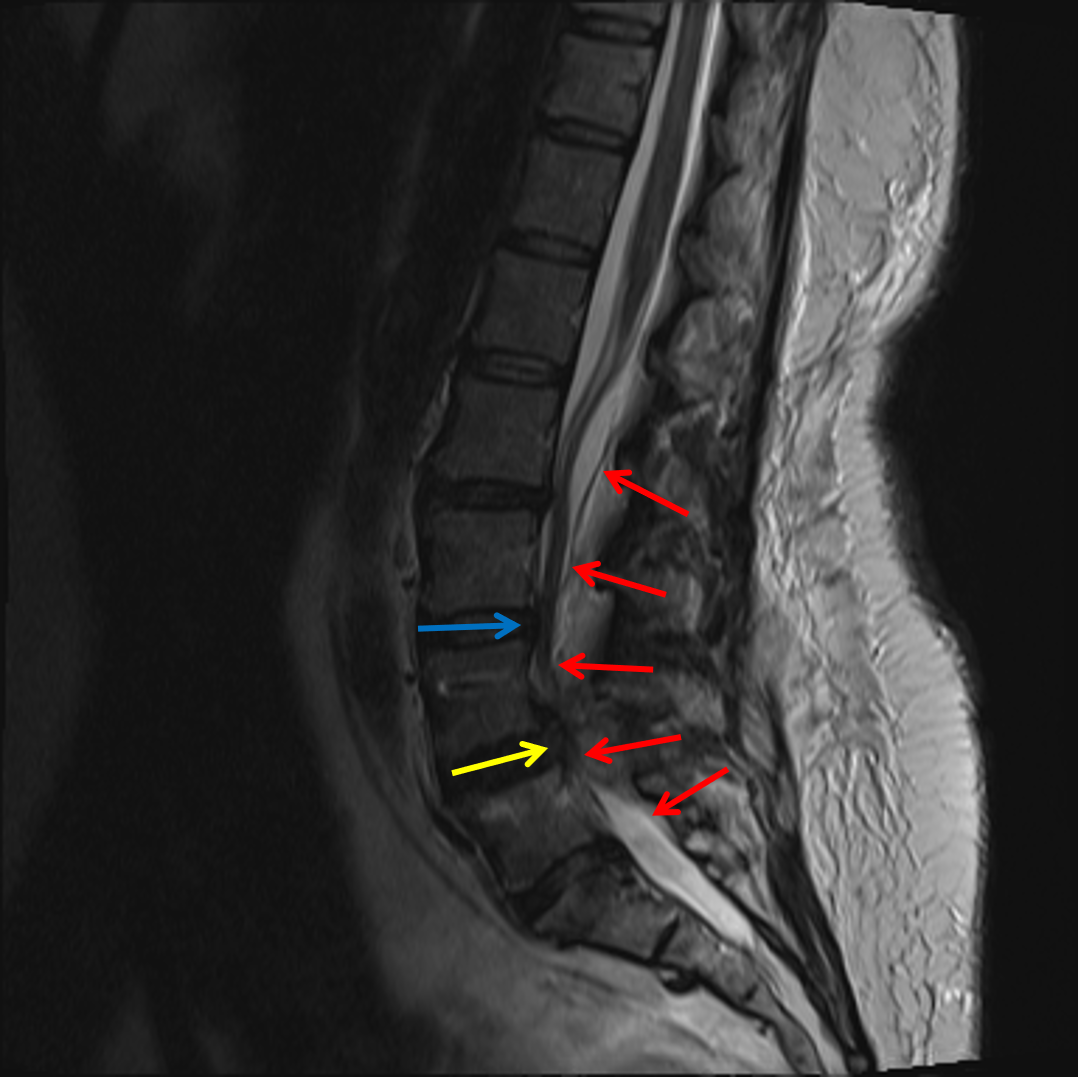 Epidural Hematoma Spine Mri