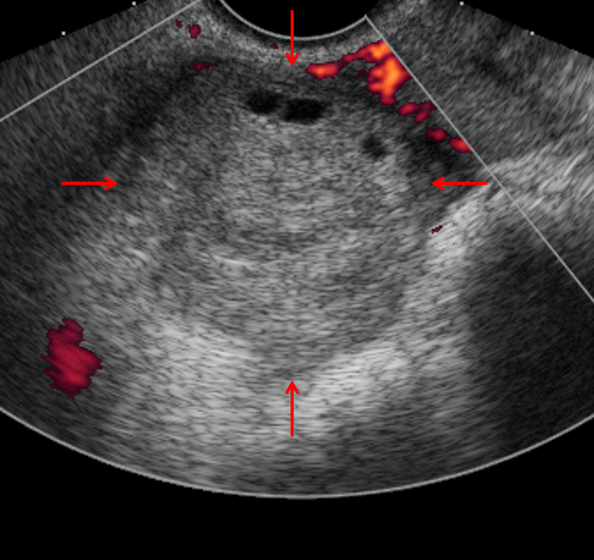 Ovarian Torsion Ultrasound