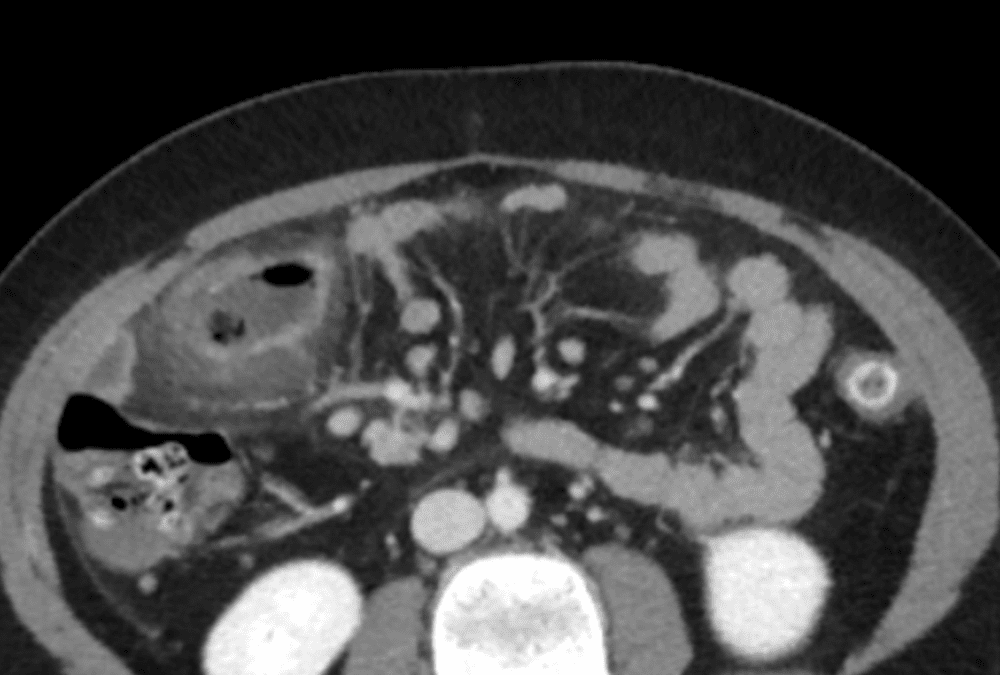 Lower Abdominal Pain