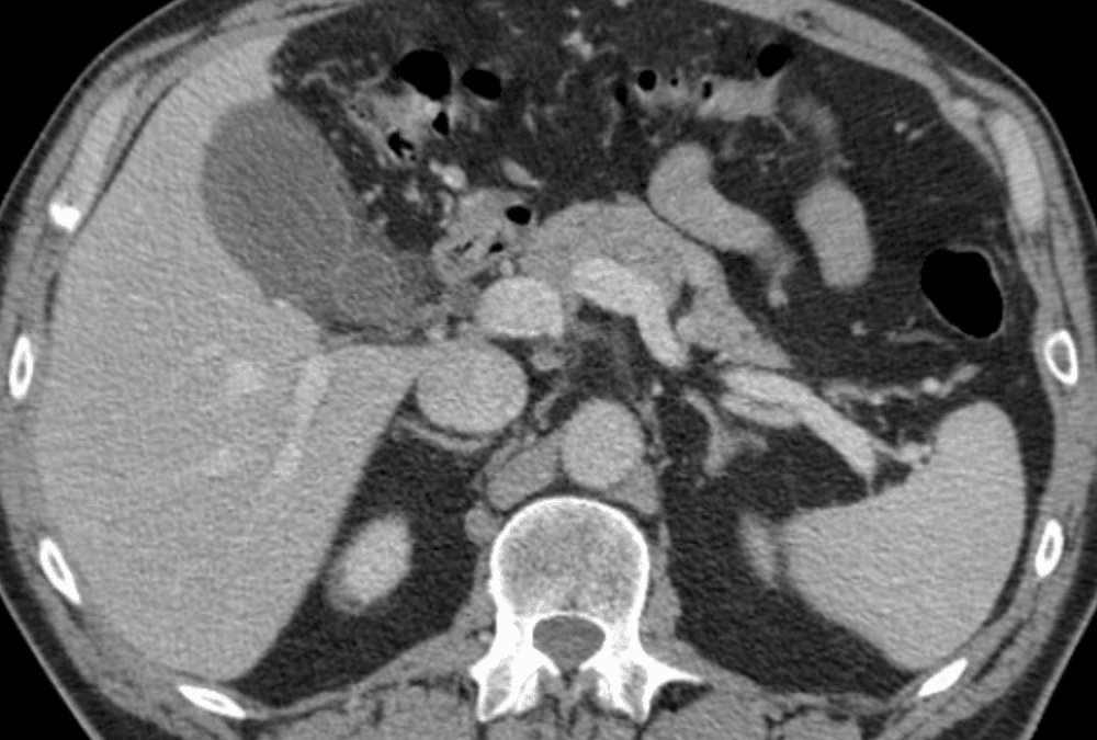 Upper Abdominal Pain