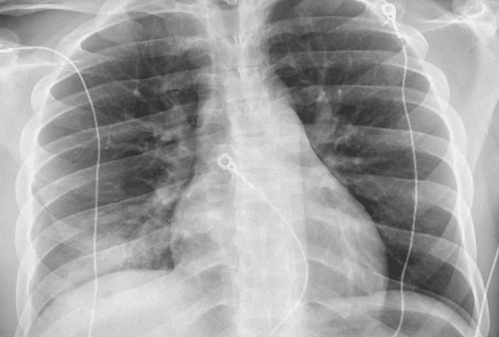 Chest Radiograph Cases – Lung Pathology