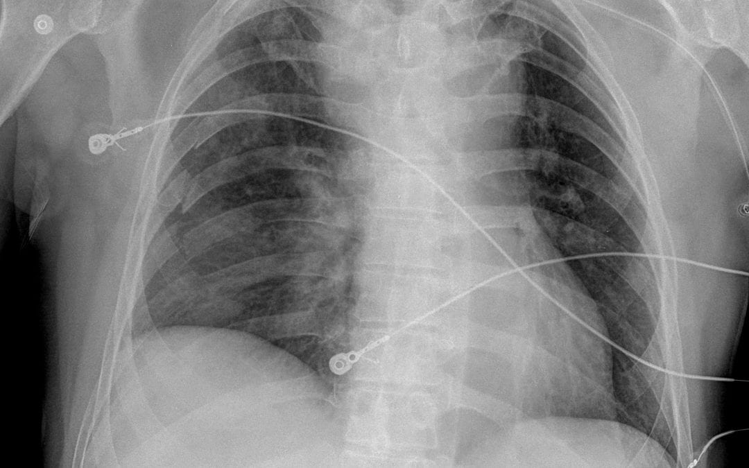 Chest Radiograph Cases – Mediastinum Pathology