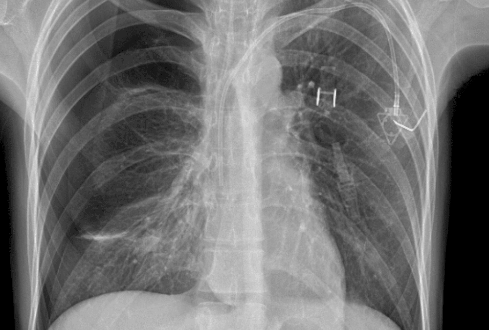 Chest Radiograph Practice Cases