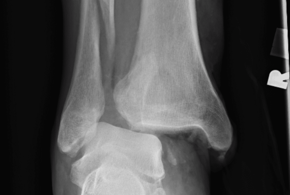 MSK – Ankle and Foot Radiographs