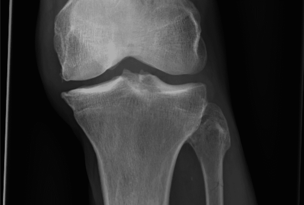 MSK – Femur and Knee Radiographs