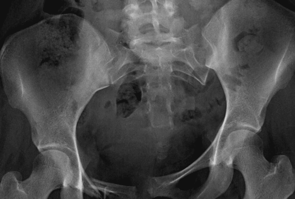 MSK – Pelvis and Hip Radiographs