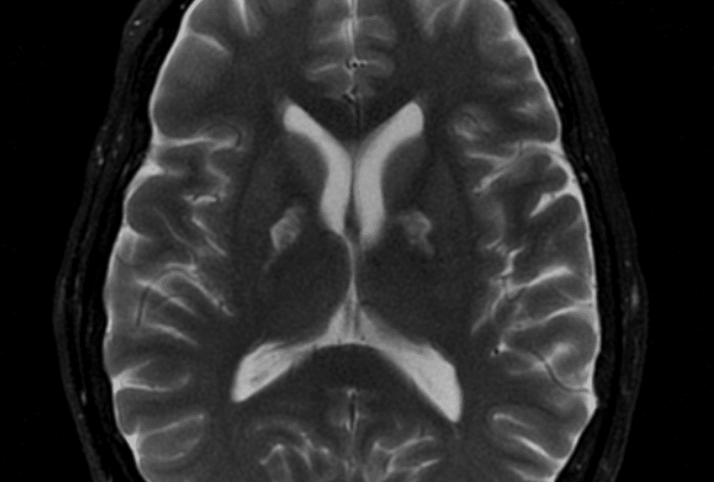 Brain MRI Cases