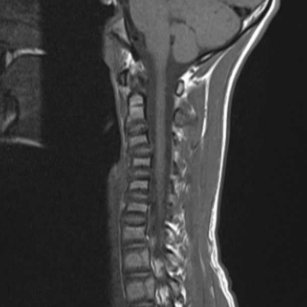 Spine MRI Cases