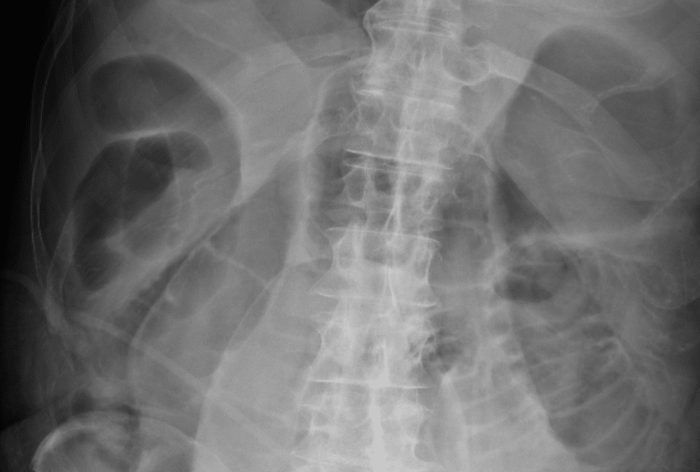 abdominal-radiograph-casestacks