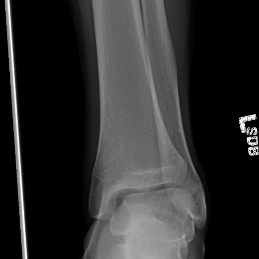 normal pediatric ankle xray