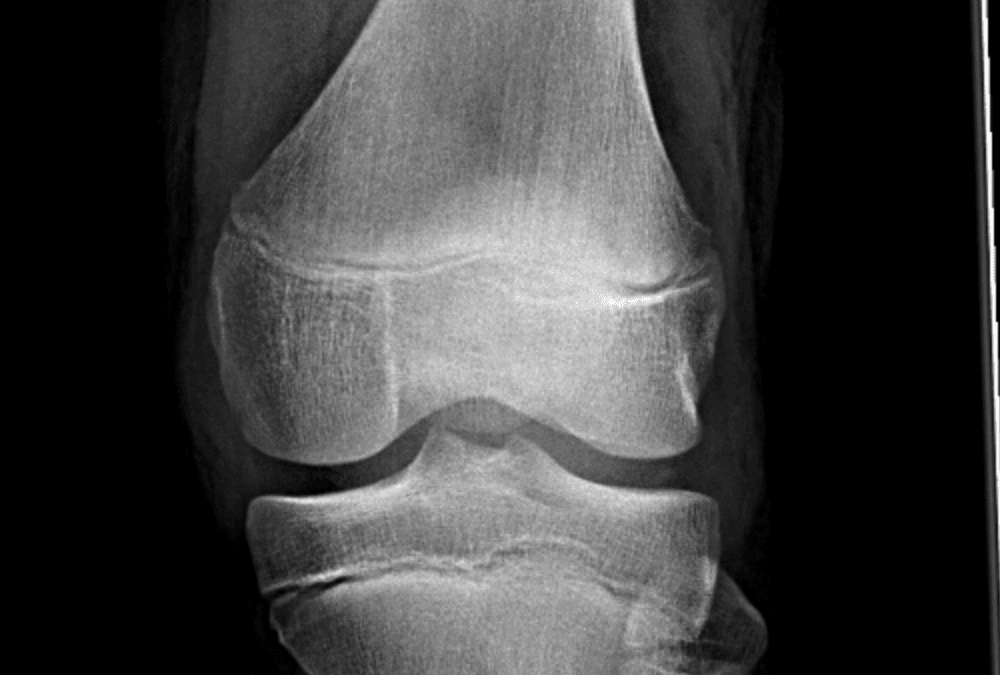 Peds MSK – Femur/Knee