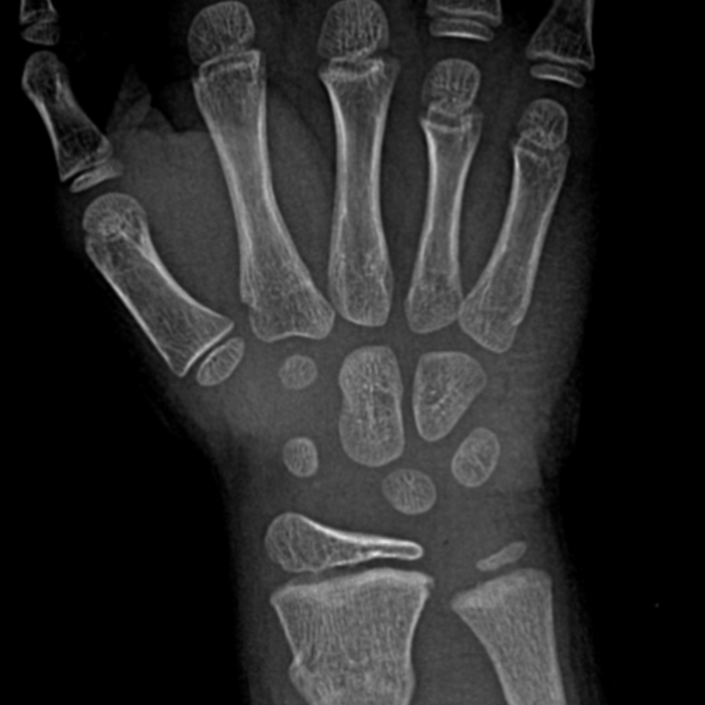 Top 93+ Pictures Normal X-ray Of Hand And Wrist Sharp