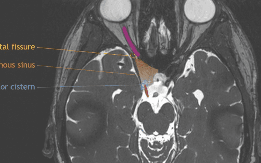 Cranial Nerve Anatomy on MRI