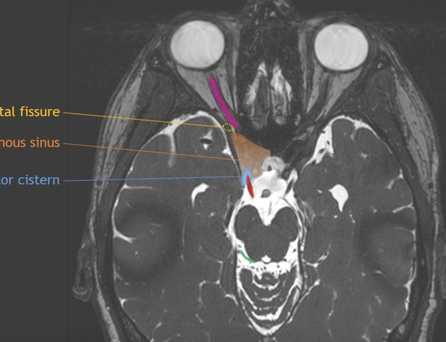 Cranial Nerve Anatomy On Mri 4481