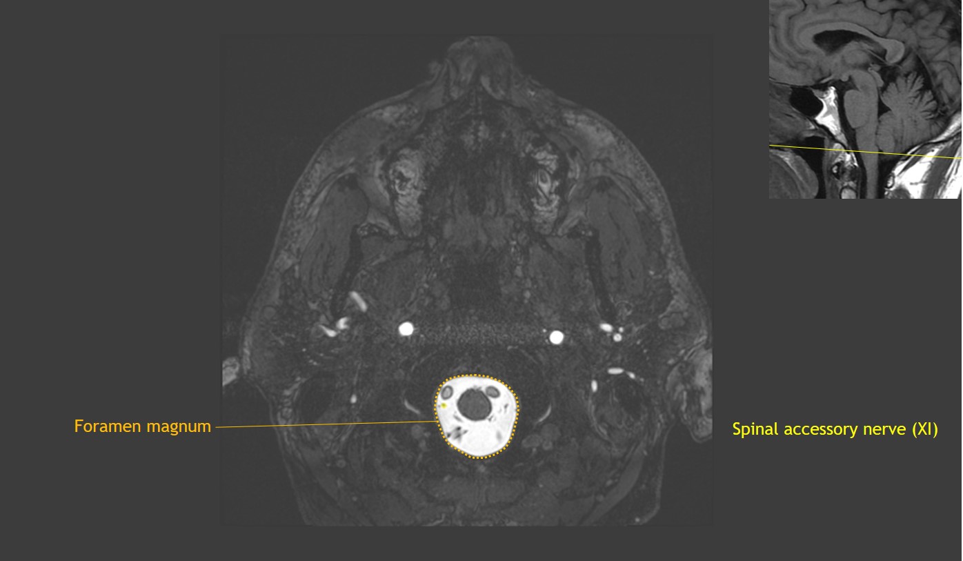 CaseStacks.com - Cranial Nerve Anatomy on MRI