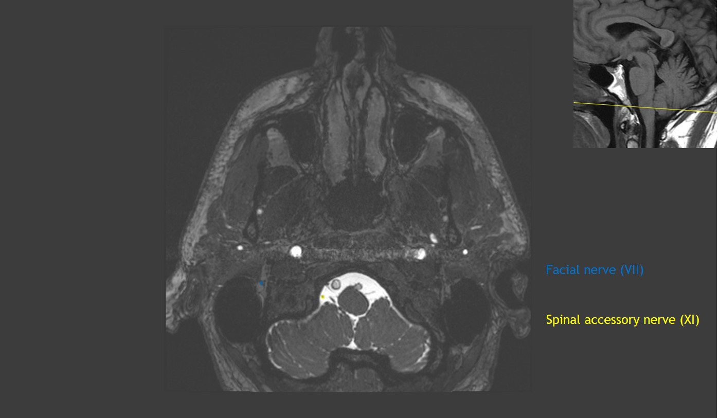 Cranial Nerve Anatomy on MRI | CaseStacks.com