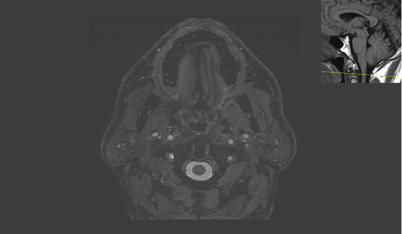 CaseStacks.com - Cranial Nerve Anatomy on MRI