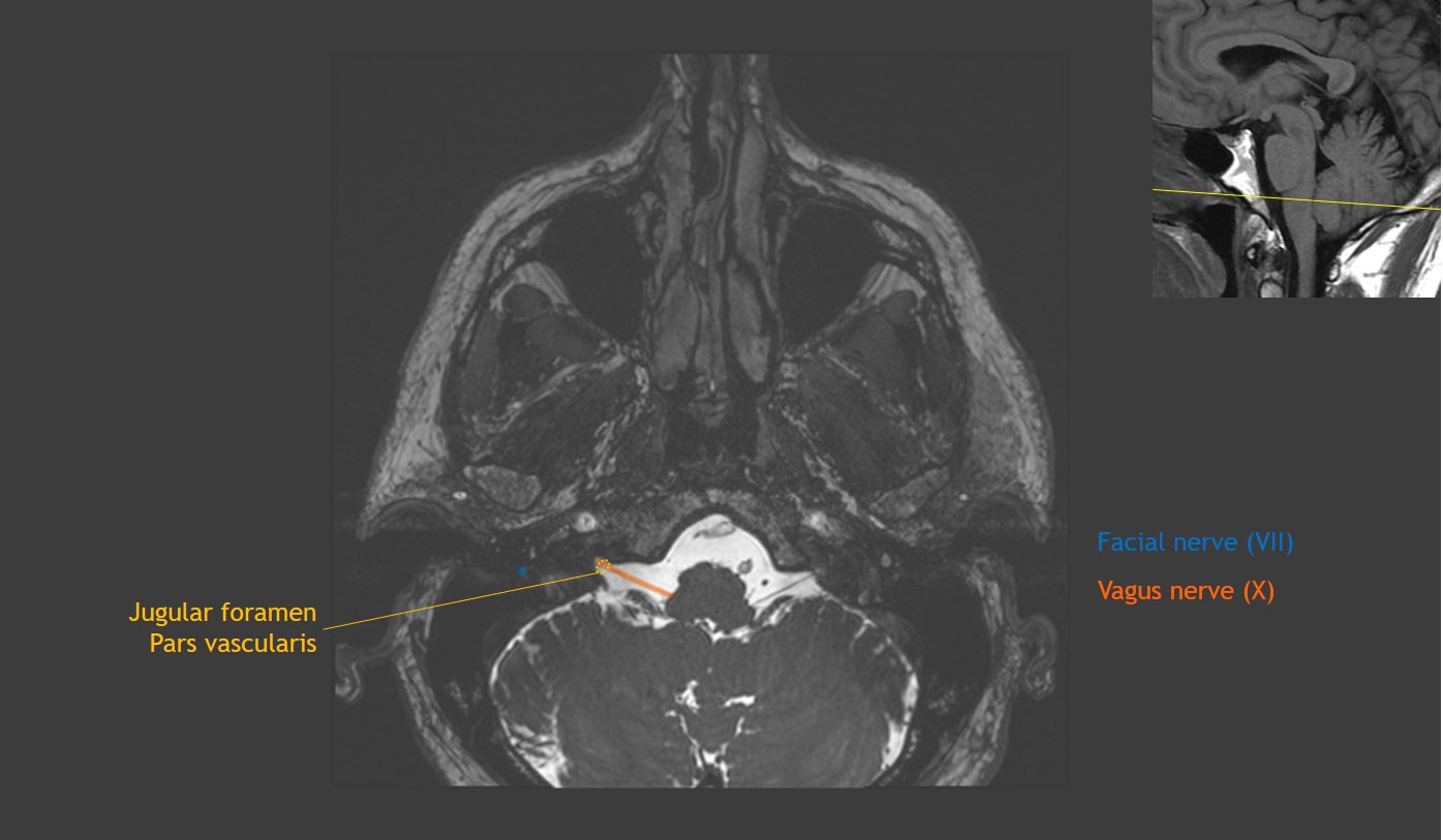 CaseStacks.com - Cranial Nerve Anatomy on MRI