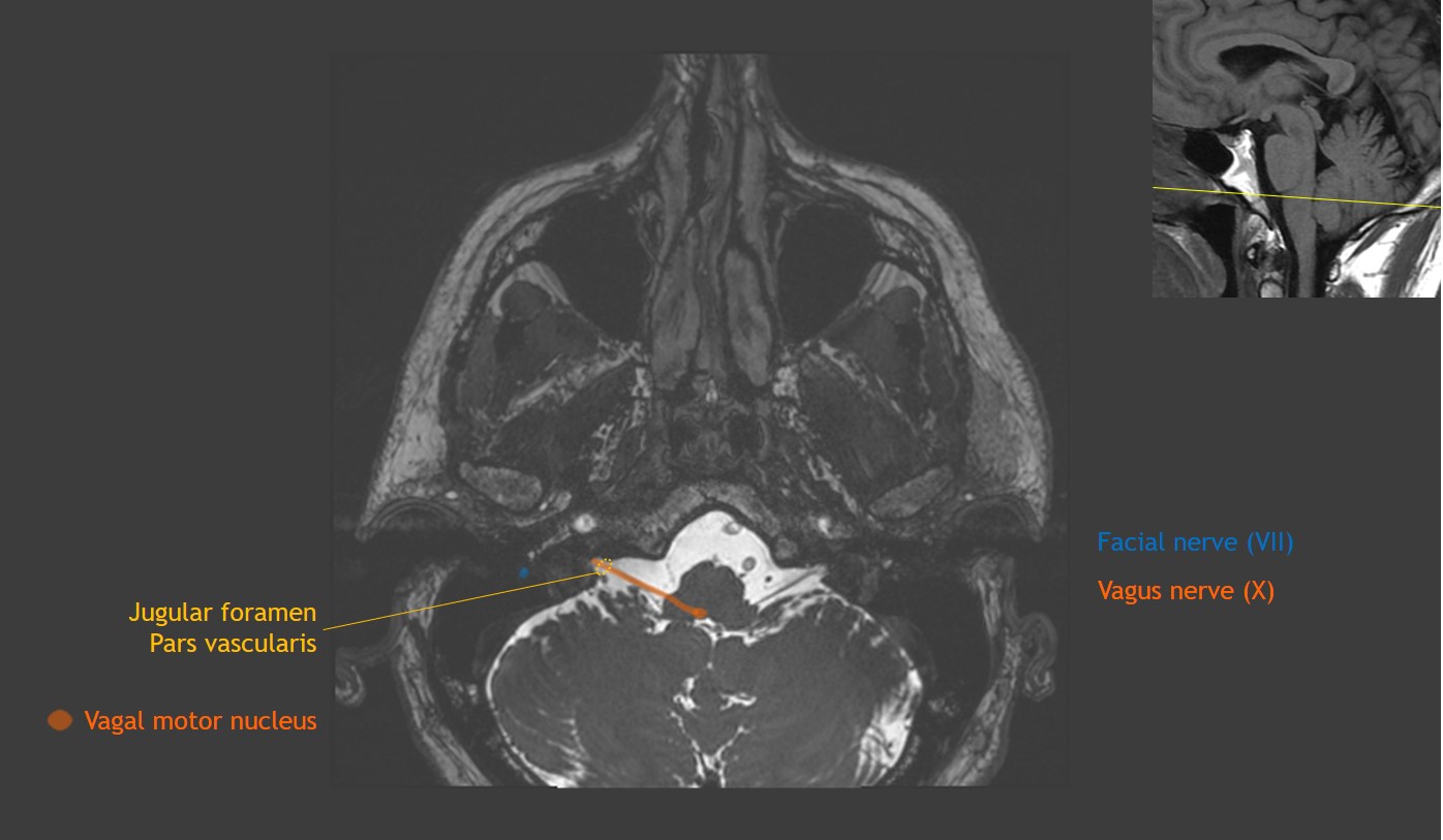 Cranial Nerve Anatomy on MRI | CaseStacks.com