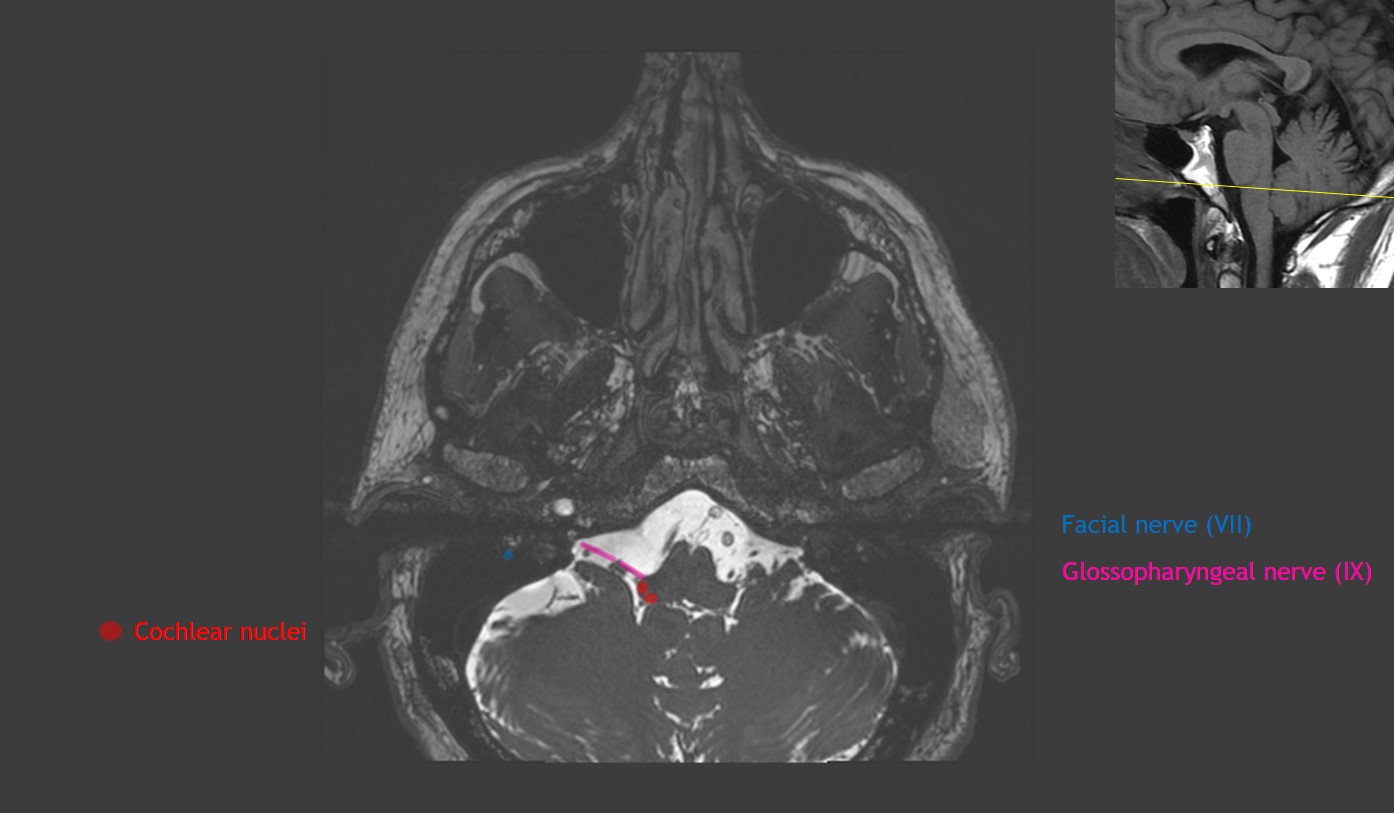 CaseStacks.com - Cranial Nerve Anatomy on MRI