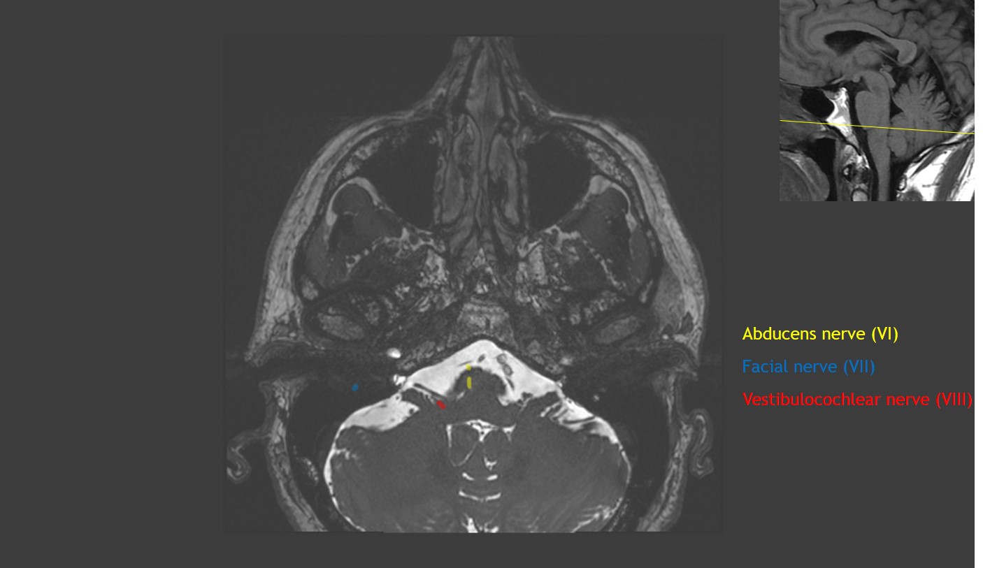 CaseStacks.com - Cranial Nerve Anatomy on MRI