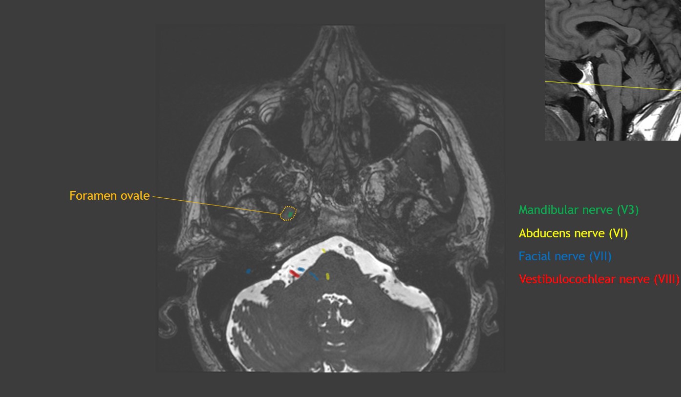 CaseStacks.com - Cranial Nerve Anatomy on MRI