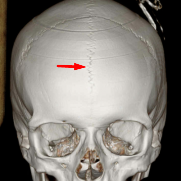 Metopic Suture