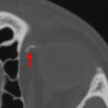 Trochlear Calcification