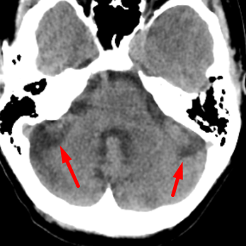 Cerebellar Horizontal Fissure