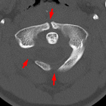 Congenital Anomalies of C1