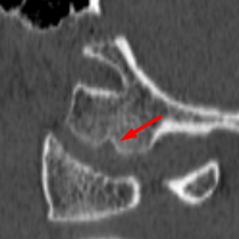 Medial Occipital Condyle “Notch”