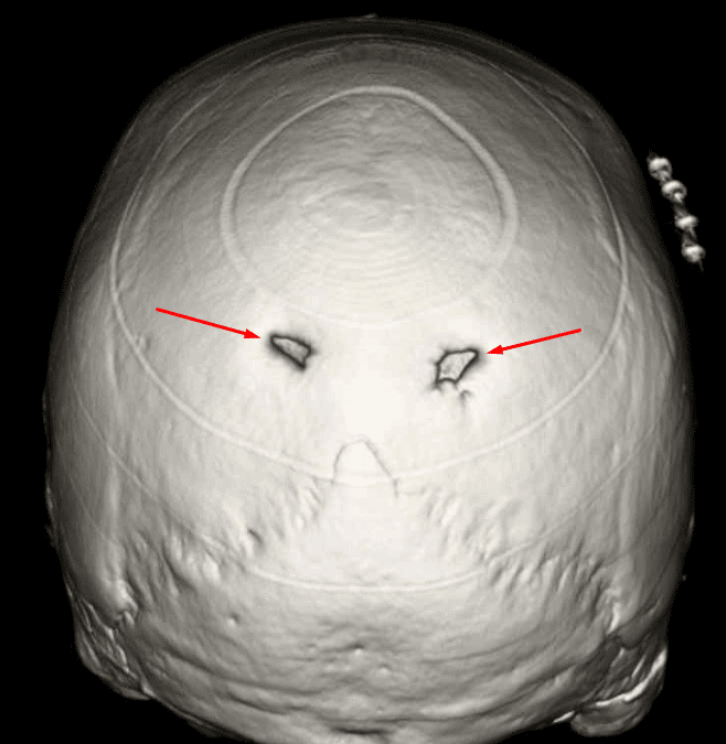 Enlarged Parietal Foramina