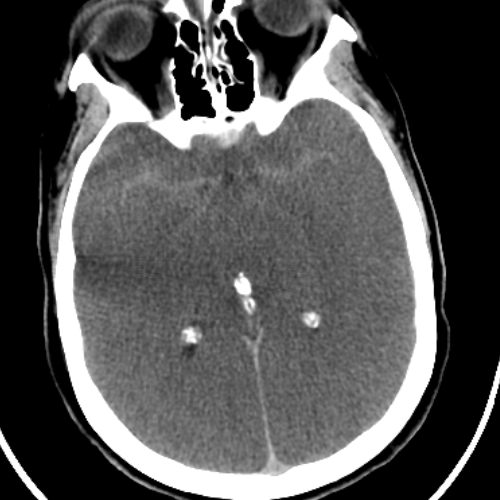 Pseudo-Subarachnoid Hemorrhage