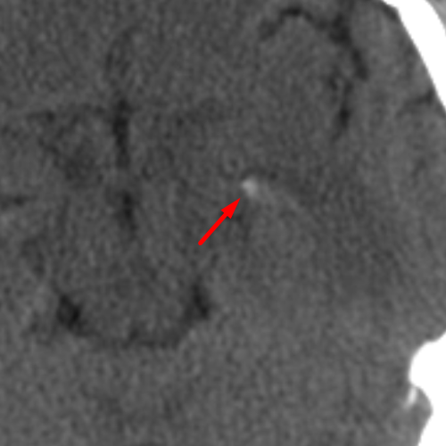 Choroid Plexus in the Temporal Horn