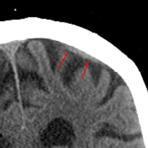 Cortical Vein