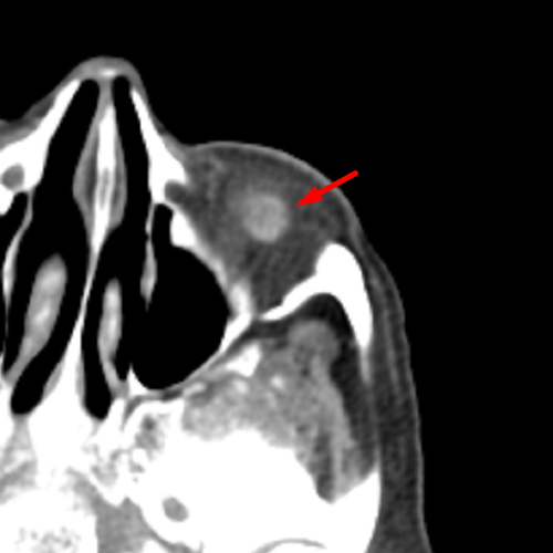 Inferior Oblique Muscle