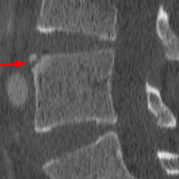 limbus vertebra casestacks